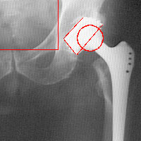 Estudio de la evolución de la prótesis de cadera después de un tiempo de su implantación